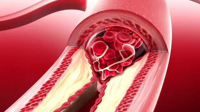 Ornidazol para Infecciones Cardiovasculares: Una Guía Exhaustiva